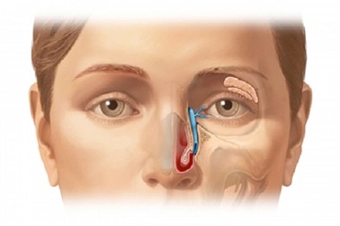 Biến chứng khôn lường từ viêm xoang