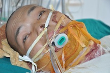 Bị bỏng nặng khi đi bắt ong, tính mạng chàng trai trẻ nguy kịch