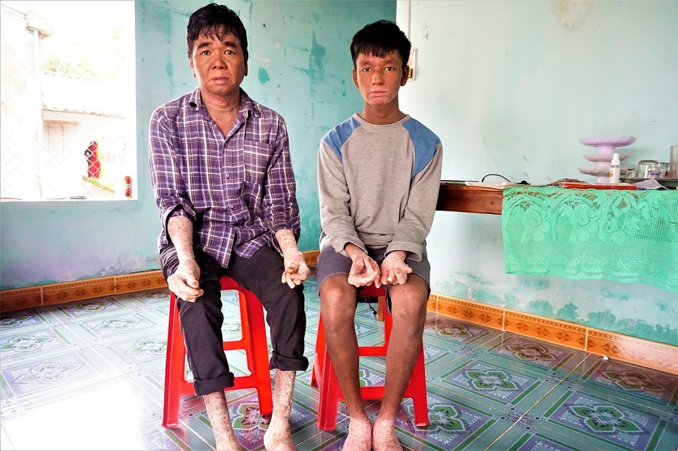 Cuộc sống của cậu bé người rắn từng bị xa lánh bây giờ ra sao? - 1 Cuộc sống của cậu bé người rắn từng bị xa lánh bây giờ ra sao? - 1