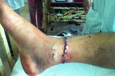 Nối thành công cổ chân bị đứt lìa