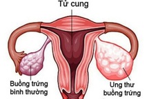 Ai có nguy cơ mắc ung thư buồng trứng?