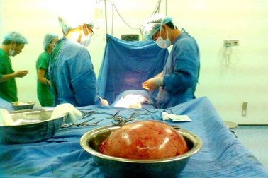 Mổ thành công khối u xơ tử cung nặng 3kg