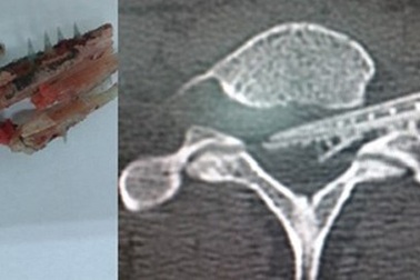 Bé 12 tuổi bị đâm liệt hai chân