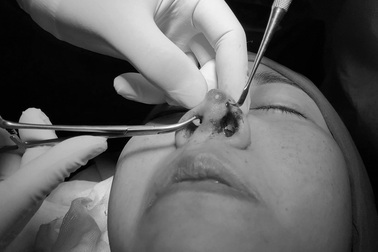 Thảm họa làm đẹp bởi các "đao phủ" thẩm mỹ dỏm