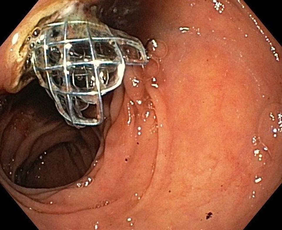 Đặt stent mật tụy ngược dòng cứu bệnh nhân ung thư tắc nghẽn đường mật - 1 Đặt stent mật tụy ngược dòng cứu bệnh nhân ung thư tắc nghẽn đường mật - 1