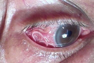 Rùng mình cảnh bác sĩ “bắt” giun ký sinh khỏi mắt người