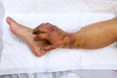 65 ngày làm nên phép màu cho thai phụ phải ghép tạm tay đứt lìa vào chân