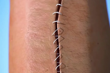 Vết thương hở sau khi được khâu sẽ như thế nào?