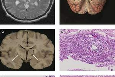 Đề phòng bệnh nhiễm não mô cầu trở lại