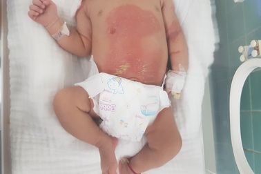Bé 14 ngày tuổi bỏng nặng vì đắp lá trầu không chữa chướng bụng