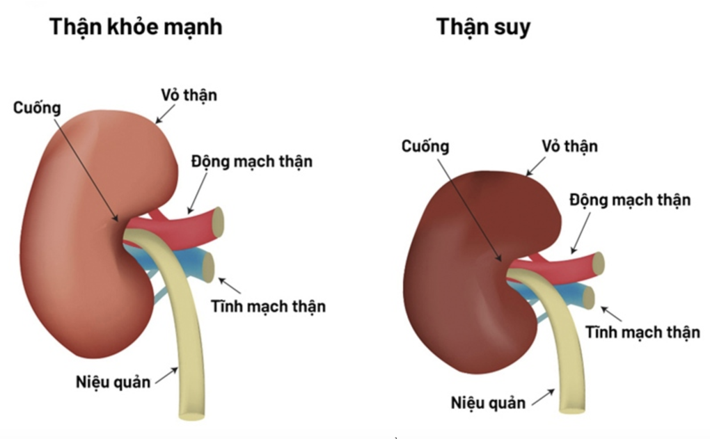 Uống cỏ mực chữa suy thận theo bác sĩ Google, nữ bệnh nhân lâm nguy - 2 Uống cỏ mực chữa suy thận theo bác sĩ Google, nữ bệnh nhân lâm nguy - 2