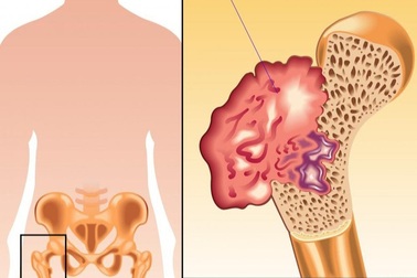 Ung thư xương khó phát hiện sớm, những ai cần cảnh giác với bệnh?