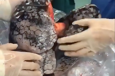 “Ám ảnh” lá phổi đen kịt của người 30 năm nghiện thuốc lá