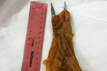 90 phút cấp cứu cho thiếu nữ 15 tuổi ở miền Tây bị kéo đâm xuyên sọ