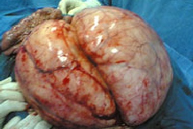 Khối u bụng khổng lồ 16kg