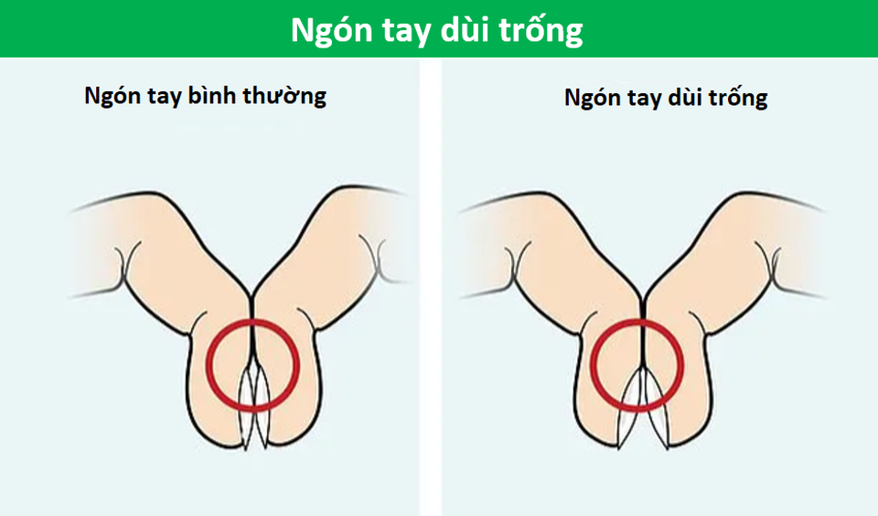 Áp 2 ngón tay vào nhau không thấy khoảng hở: Cảnh giác với bệnh nan y - 6 Áp 2 ngón tay vào nhau không thấy khoảng hở: Cảnh giác với bệnh nan y - 6