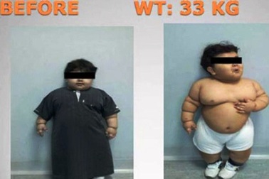 Bé 2 tuổi được phẫu thuật dạ dày để giảm béo