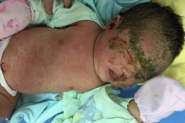 Bé sơ sinh 1 tháng tuổi chảy mủ toàn thân vì tắm lá