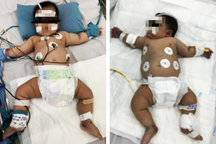 Hạ sốt sau khi uống thuốc, 2 trẻ vẫn nguy kịch vì sốt xuất huyết