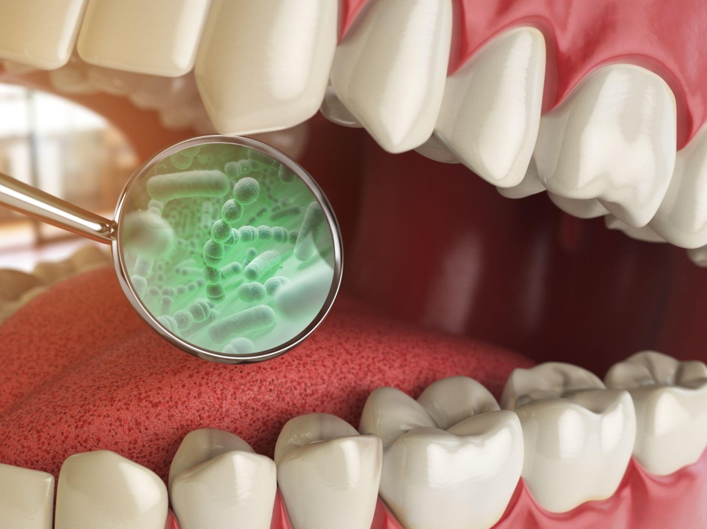 Lời khuyên từ bác sĩ để giảm tình trạng hôi miệng ở người niềng răng sau ăn - 2 Lời khuyên từ bác sĩ để giảm tình trạng hôi miệng ở người niềng răng sau ăn - 2