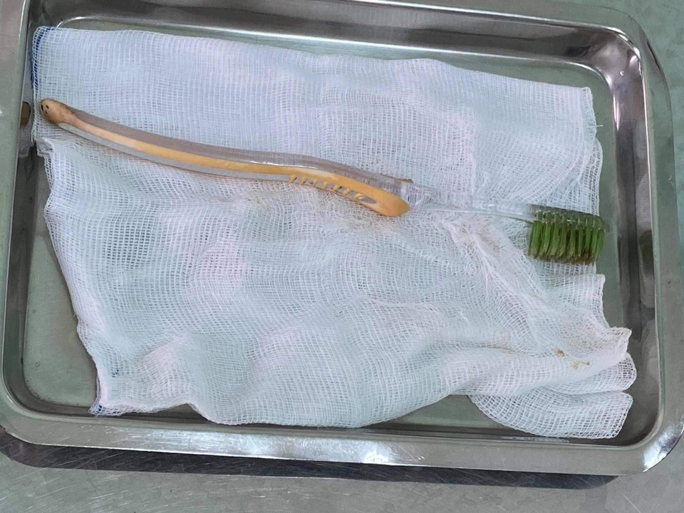Bé gái 13 tuổi “nuốt chửng” bàn chải đánh răng dài 20cm - 1