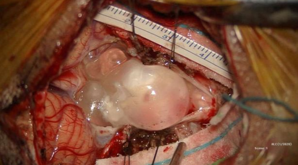Nghi có khối u, cô gái không ngờ bị ấu trùng sán dây ký sinh trong não - 3 Nghi có khối u, cô gái không ngờ bị ấu trùng sán dây ký sinh trong não - 3
