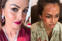 Sốc với ảnh minh tinh Ấn Độ bị chồng đánh chảy máu đầu