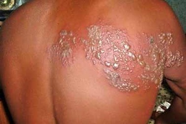 Sắp có vắc-xin phòng bệnh giời leo