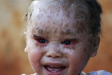 Cuộc sống lay lắt của bé 14 tháng tuổi mở mắt khi ngủ