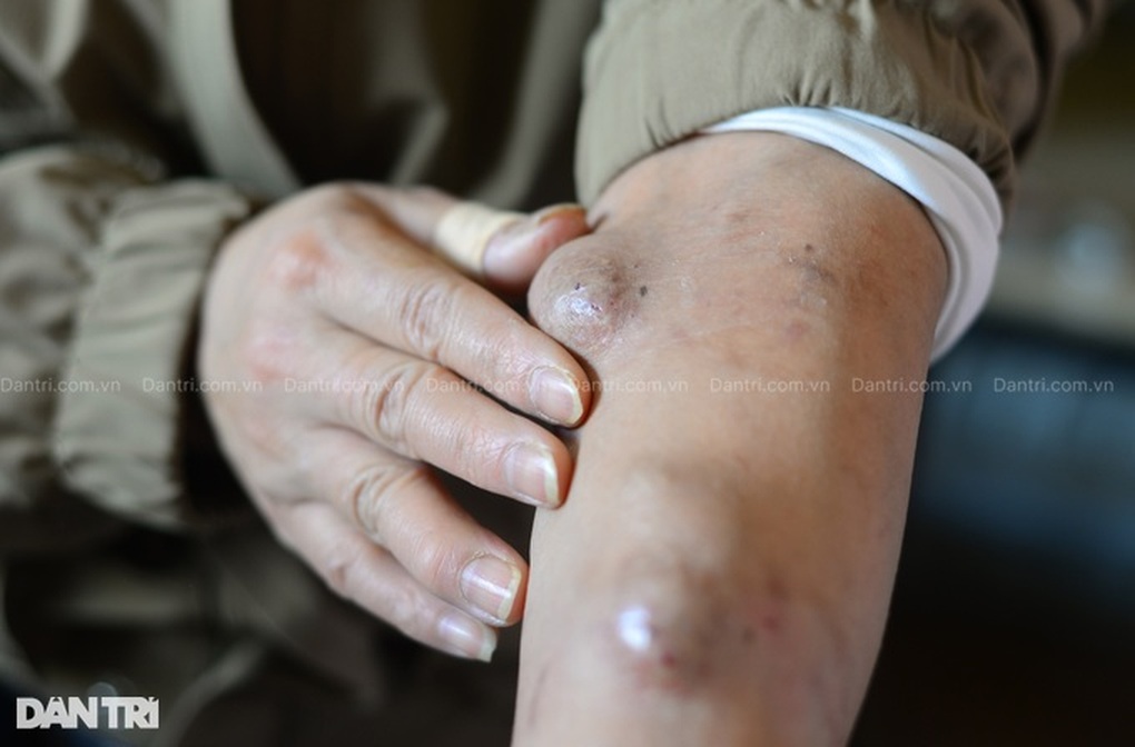Gia đình tha hương khốn khó, chồng phụ hồ nuôi vợ suy thận mạn, con u máu - 2 Gia đình tha hương khốn khó, chồng phụ hồ nuôi vợ suy thận mạn, con u máu - 2