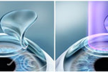 Có thể mổ cận bằng phương pháp khác ngoài SMILE không?