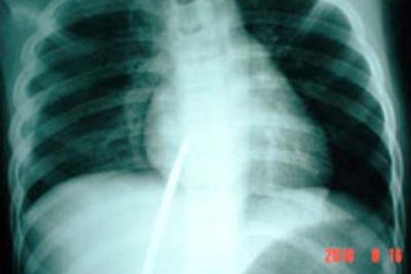 Sơ ý, một trẻ bị đâm thủng tim phổi