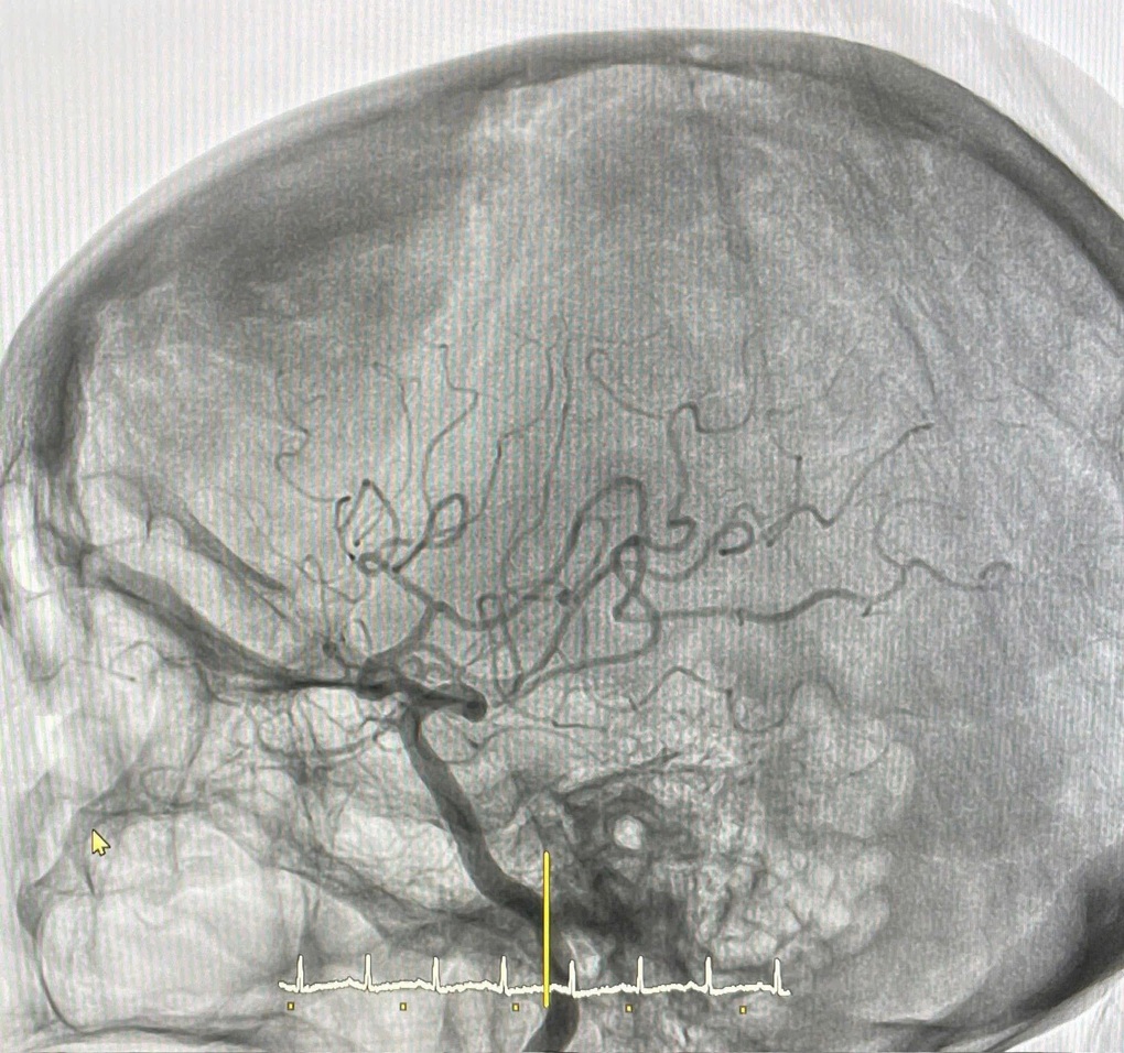 یک لخته خون تقریباً باعث شد زن مسن در هر دقیقه میلیونها سلول مغزی خود را از دست بدهد - 1 Cục máu đông khiến cụ bà suýt mất hàng triệu tế bào não mỗi phút - 1