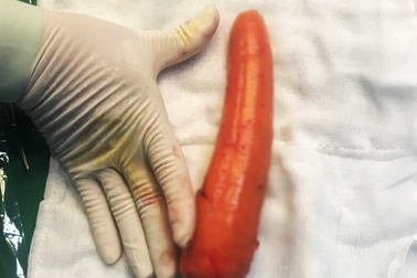 Cấp cứu thiếu niên nhét củ cà rốt 20cm vào hậu môn để... thử cảm giác lạ