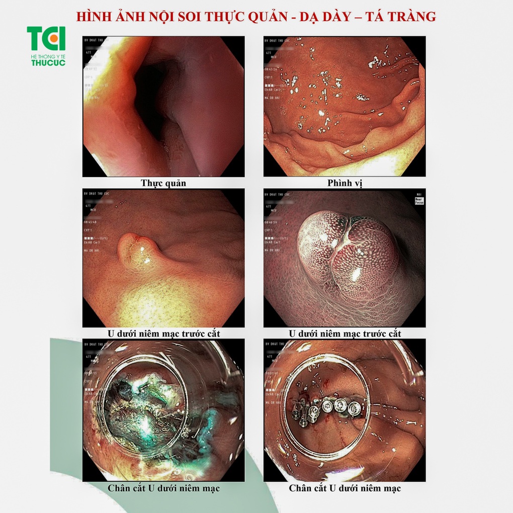 Cắt toàn bộ khối u dưới niêm mạc dạ dày không mổ mở, không đau - 3 Cắt toàn bộ khối u dưới niêm mạc dạ dày không mổ mở, không đau - 3