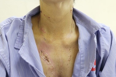 Người phụ nữ bị sét đánh tóc dựng ngược, thủng màng nhĩ, bỏng điện