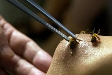 “Bạn gái Người Sắt” làm đẹp bằng cách…cho ong đốt