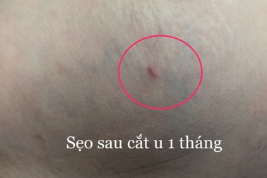 Hy vọng mới cho các chị em phải điều trị u xơ tuyến vú