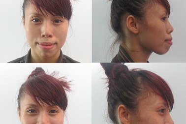 Phẫu thuật hô móm miễn phí 100% dành cho những hoàn cảnh khó khăn