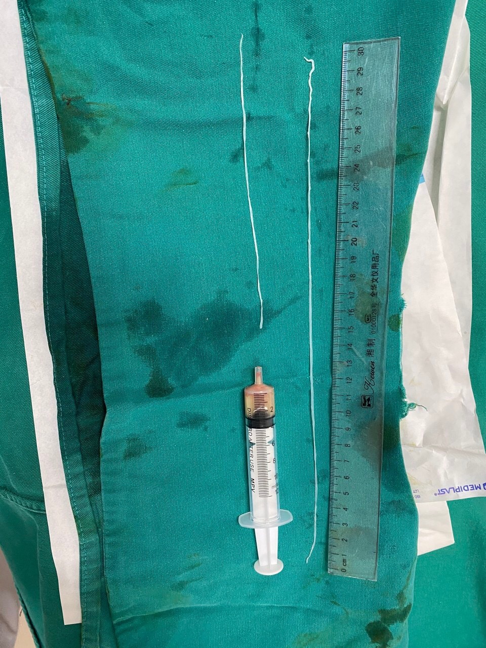 Rùng mình gắp giun lạ chưa từng có, dài tới 60cm ở tay chân bệnh nhân - 1