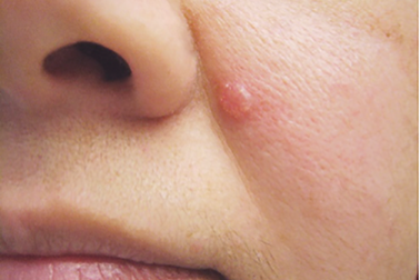 Dấu hiệu nhận biết sớm nốt ruồi ác tính