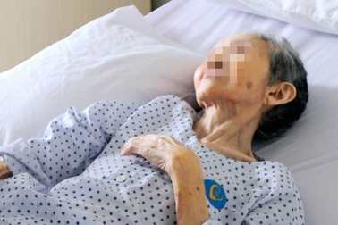 Cụ bà chỉ còn 29kg, tắc ruột hoàn toàn vì mắc căn bệnh ung thư hiểm ác