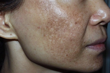 Mặt như "trận địa" sau khi bỏ 60 triệu chữa nám