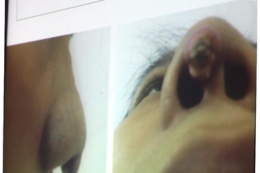 Thủng má, rách mũi vì làm đẹp đón Tết