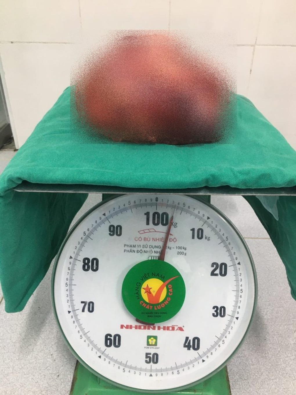 Khối u to như quả bóng trong bụng vì chủ quan không đi khám - 1 Khối u to như quả bóng trong bụng vì chủ quan không đi khám - 1