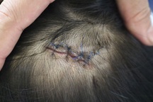 Vướng áo chống nắng, bé gái 7 tuổi bị cuốn vào bánh xe máy