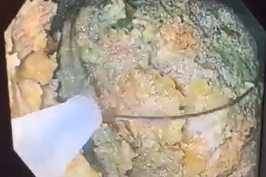 Ăn 5 quả hồng ngâm, người phụ nữ suýt tắc ruột vì khối bã to hơn nắm tay