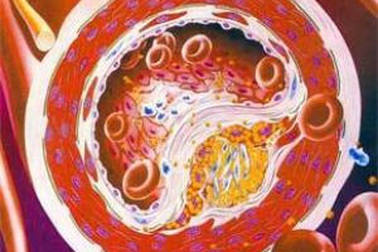 5 cách hạn chế cholesterol