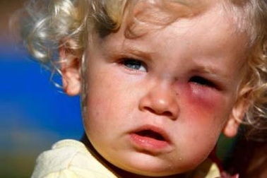 Nguy cơ mù mắt do tiếp xúc với chó nhiễm giun