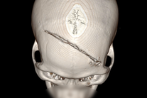 Thanh niên dập não nặng, vượt hàng trăm km đến TPHCM và cái kết vỡ oà